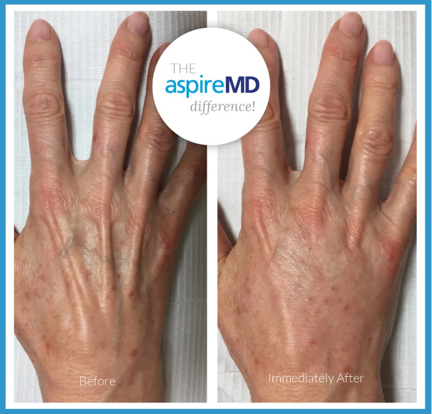 The aspireMD Difference
