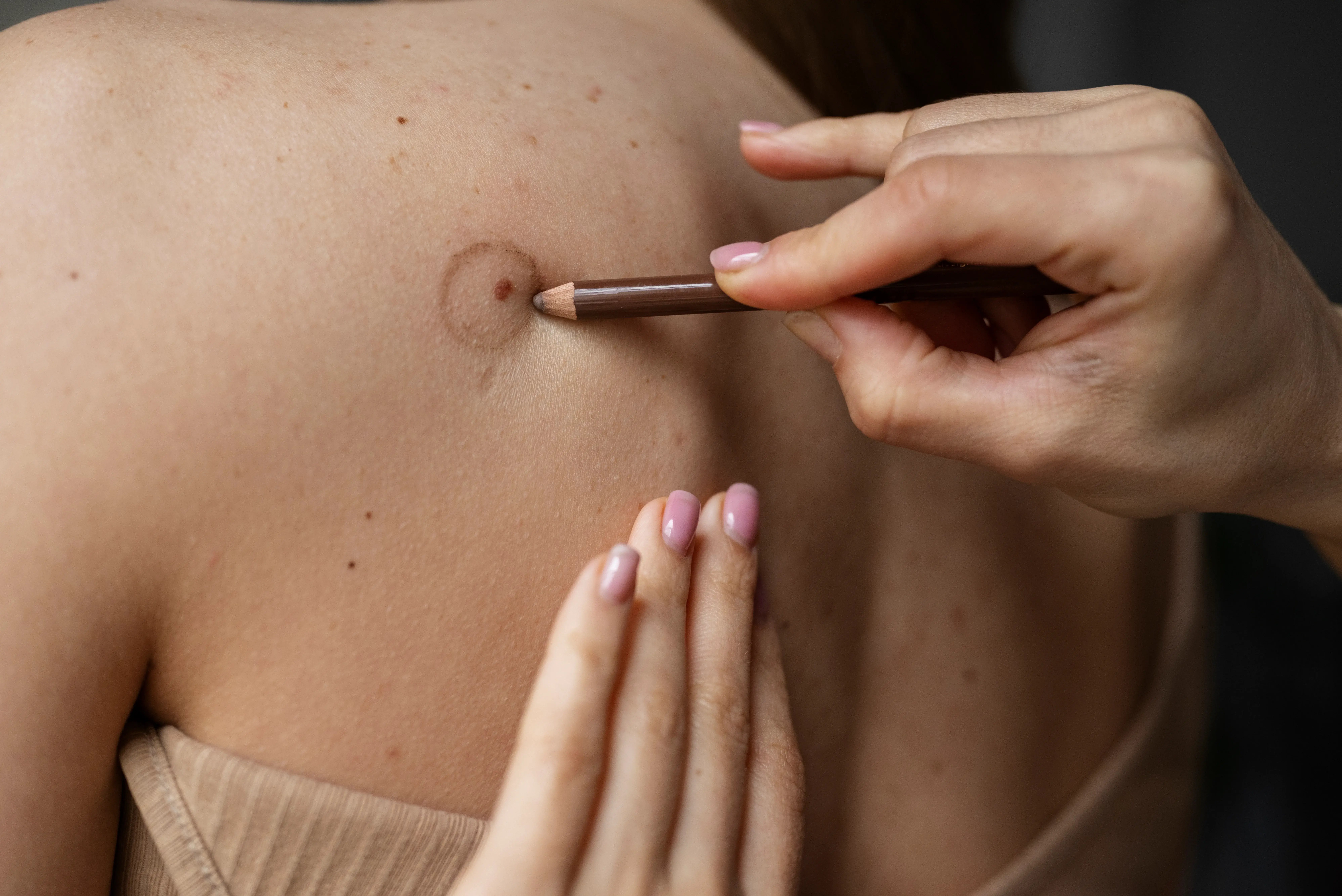 Doctor circling mole on back with pencil