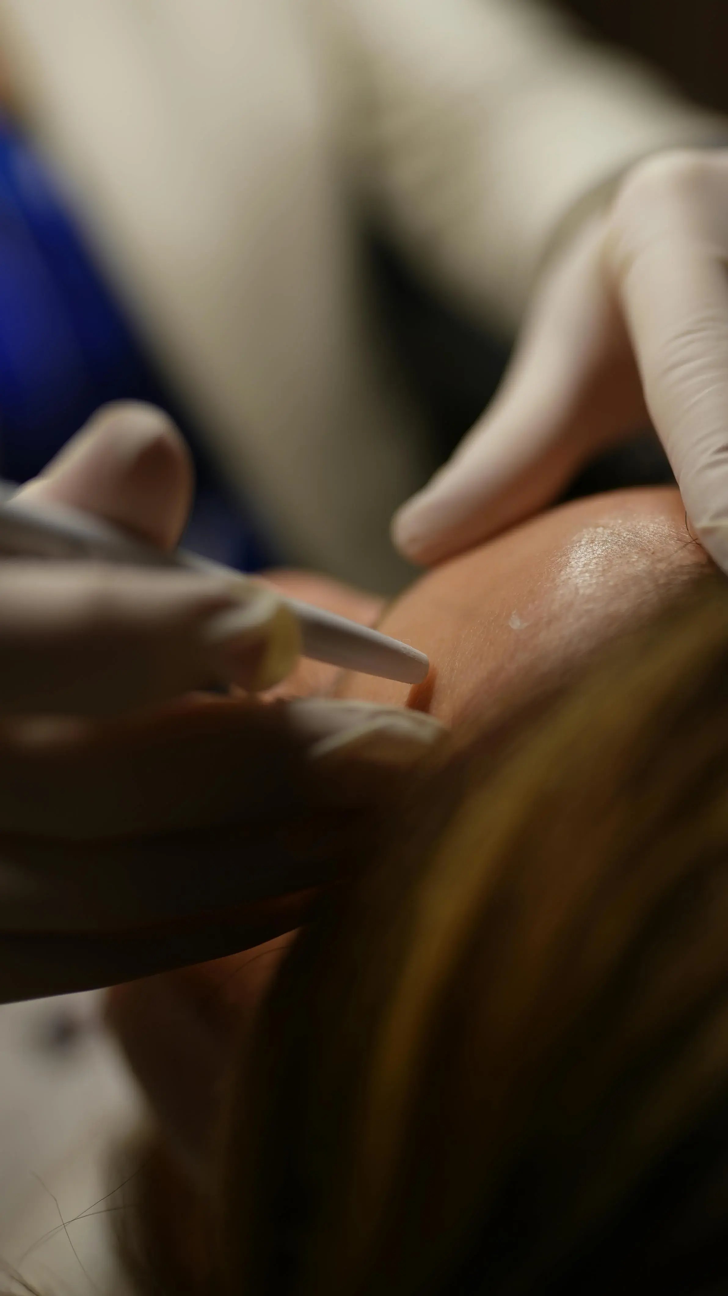 Microneedling procedure with a microneedling pen
