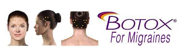 botoxformigraines