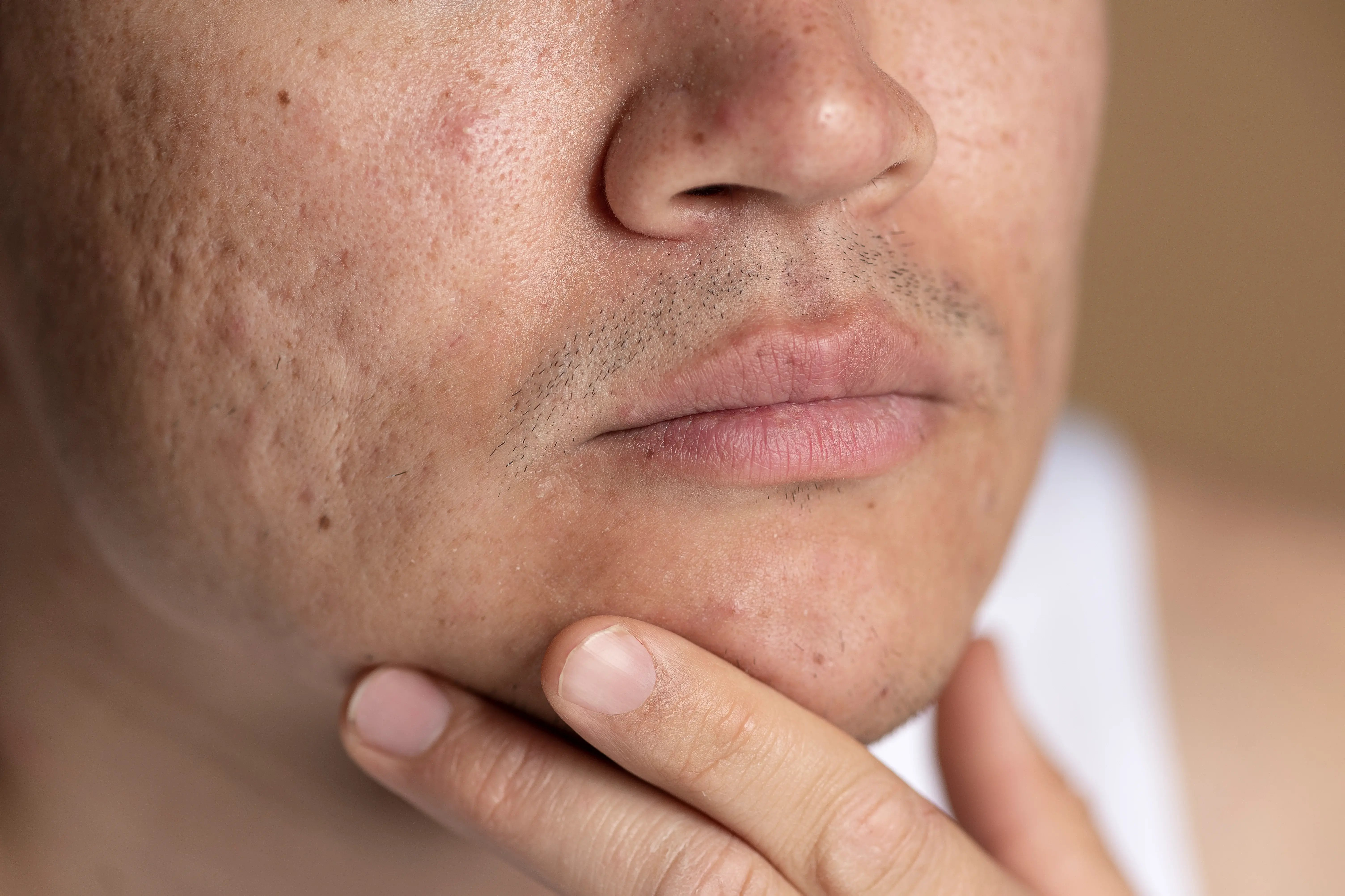 close up of acne scars on man_s face