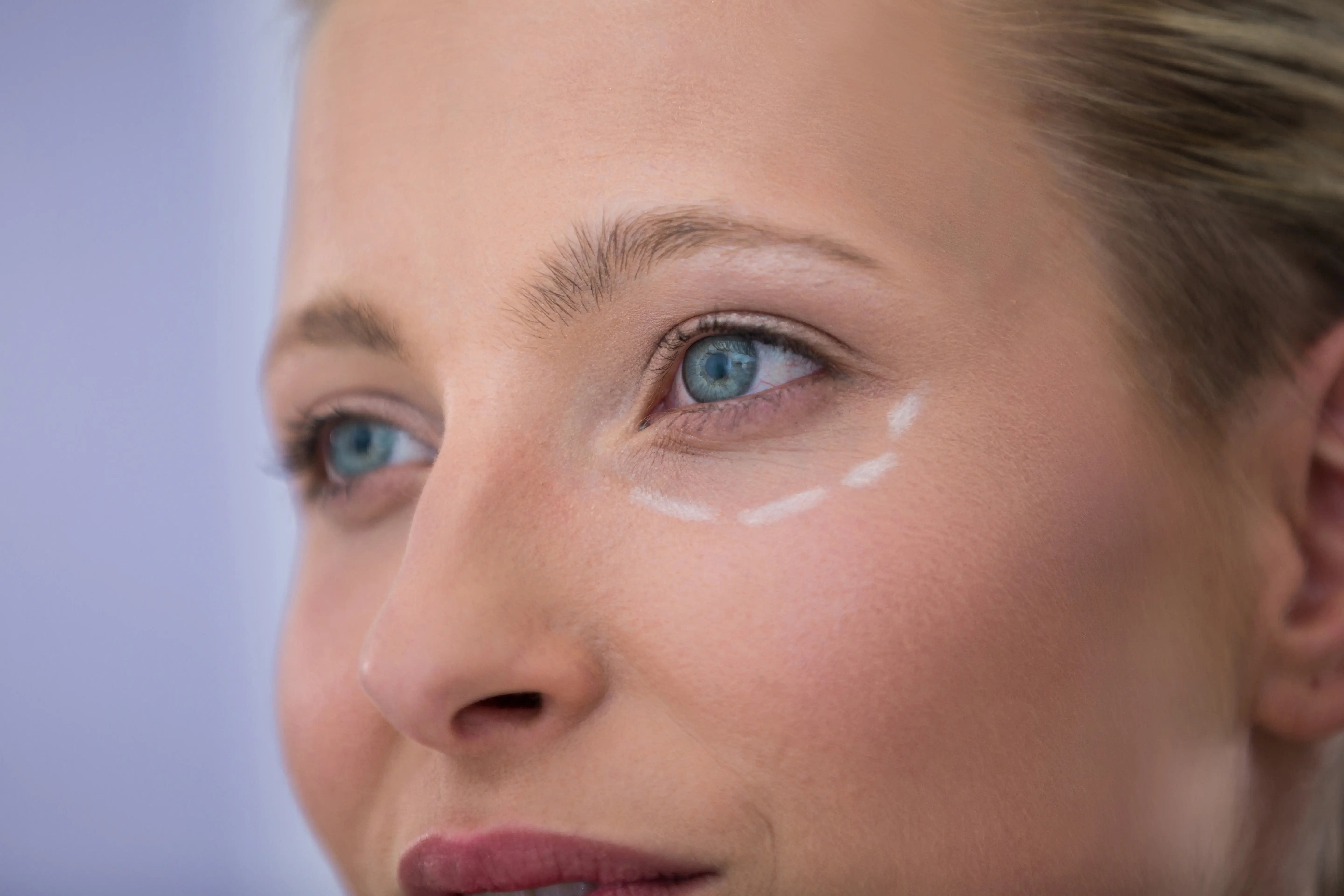 close up of women with marks drawn for cosmetic prp treatment
