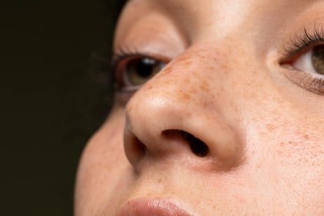 close up of women with melasma on cheek and nose