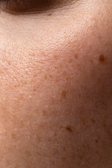 close up of women with melasma on face
