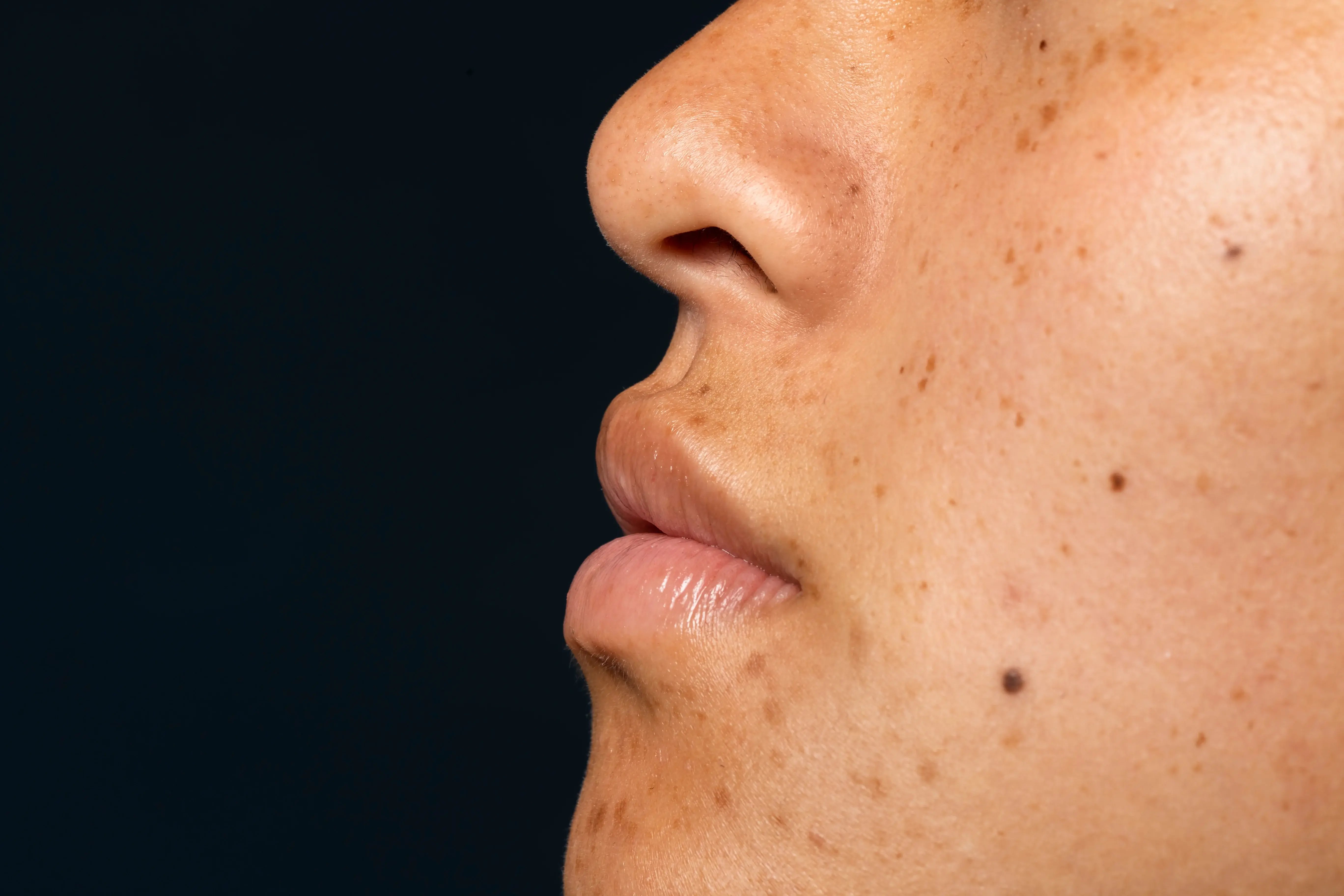 close up side view of women with hyperpigmentation dark spots