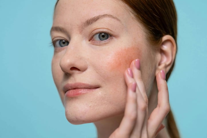 how to reduce red skin on face with aspireMD