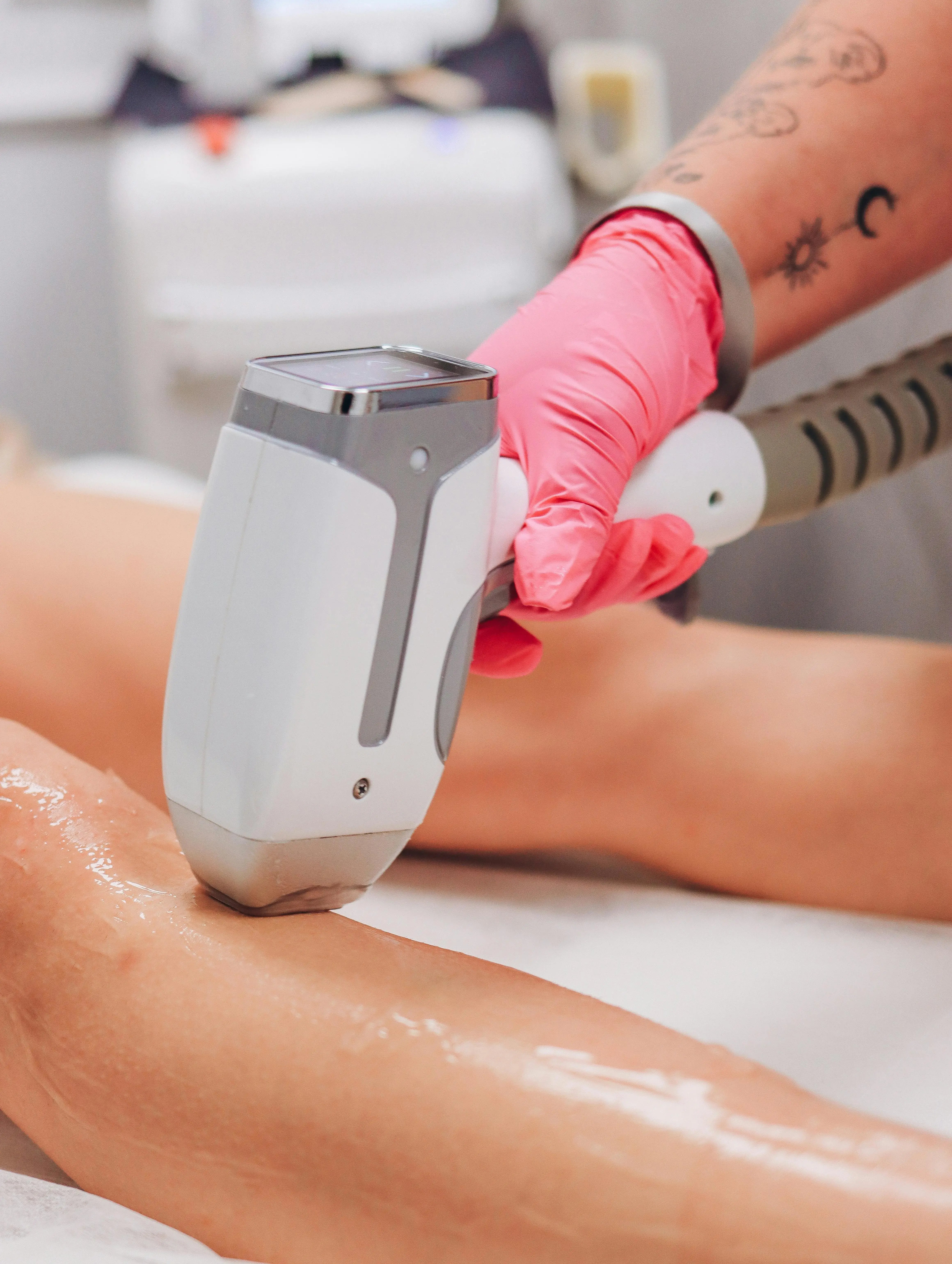 laser scar removal treatment on legs