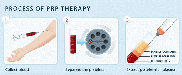 Process of PRP Therapy
