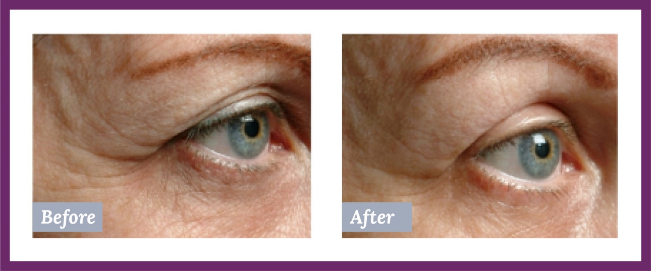 Eye Before and After