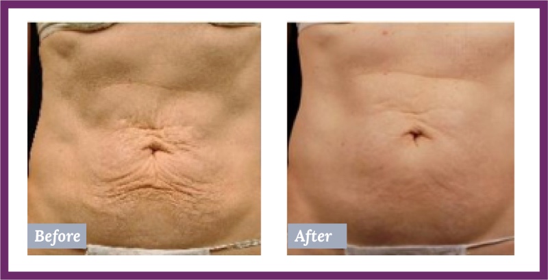 Body Before and After