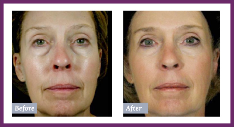 Face Before and After