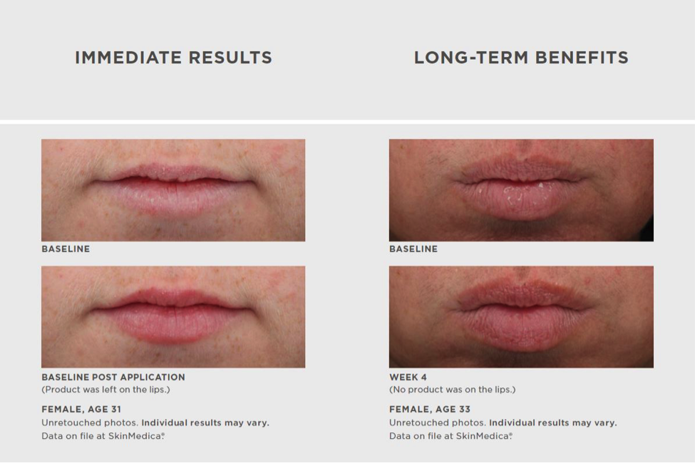 aspireMD - HA5 Lip Plump System