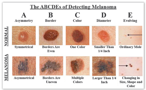 ABCDEs of Detecting Melanoma