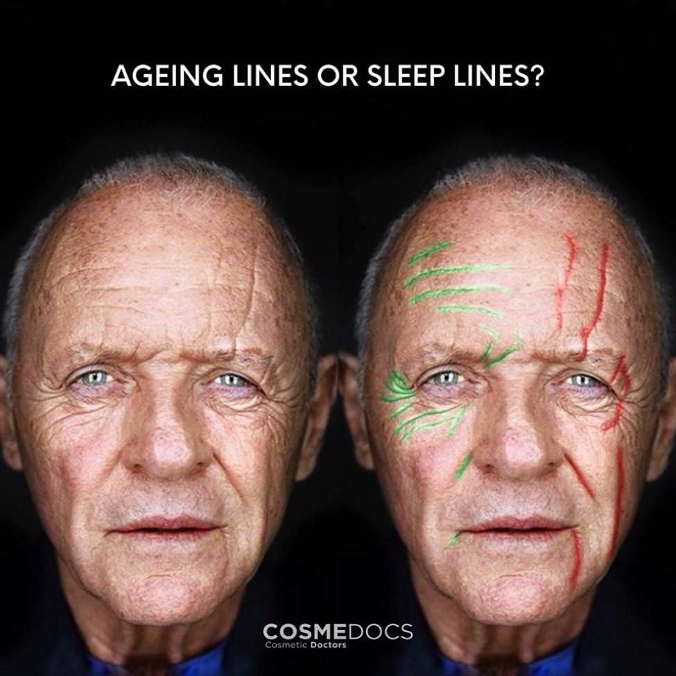 Ageing Lines or Sleep Lines